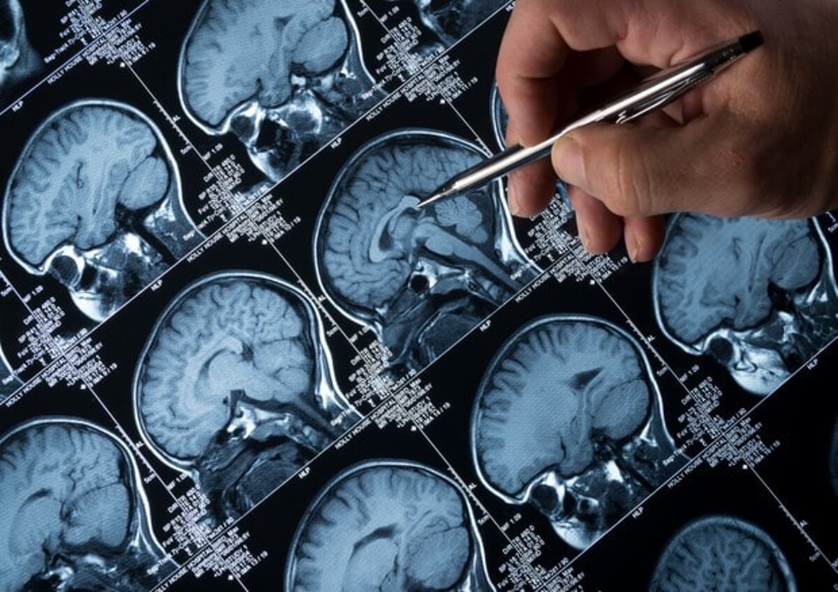 strani-sintomi-poi-la-diagnosi:-si-scopre-malato-di-alzheimer-ad-appena-19-anni